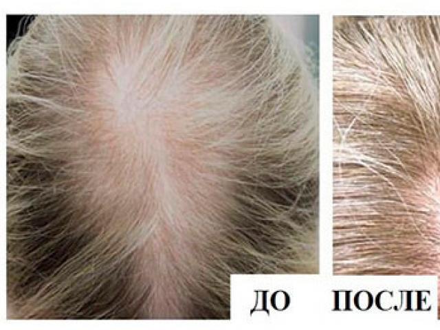 Causes and treatment of seasonal hair loss in women