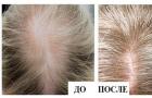 Causes and treatment of seasonal hair loss in women